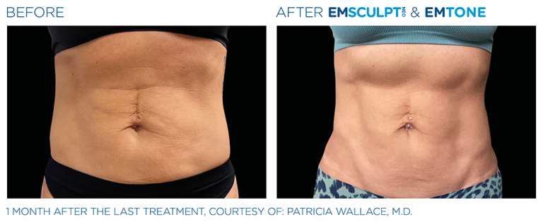 Emsculpt Abdomen