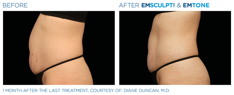 Emsculpt Abdomen