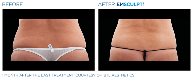 Emsculpt Abdomen