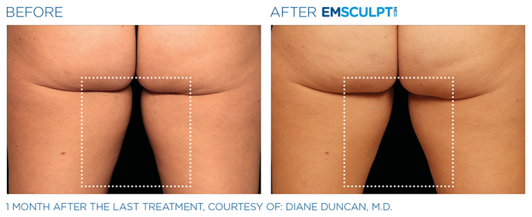 Emsculpt Thigh