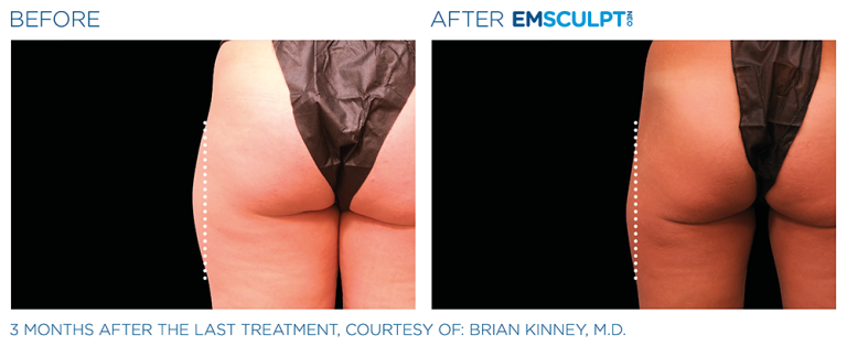 Emsculpt Thigh