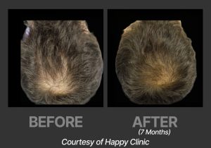 BP_BeforeAfter_DeriveHappy