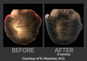 BP_BeforeAfter_DeriveNNewman