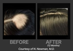 BP_BeforeAfter_DeriveNNewman2