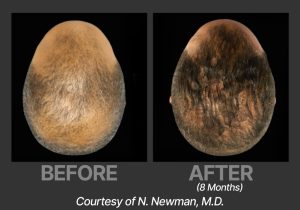 BP_BeforeAfter_DeriveNNewman3