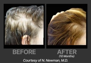 BP_BeforeAfter_DeriveNNewman4