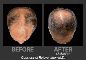 BP_BeforeAfter_DeriveRejuvenation2