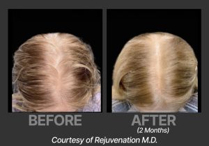 BP_BeforeAfter_DeriveRejuvenation3