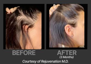 BP_BeforeAfter_DeriveRejuvenationMD